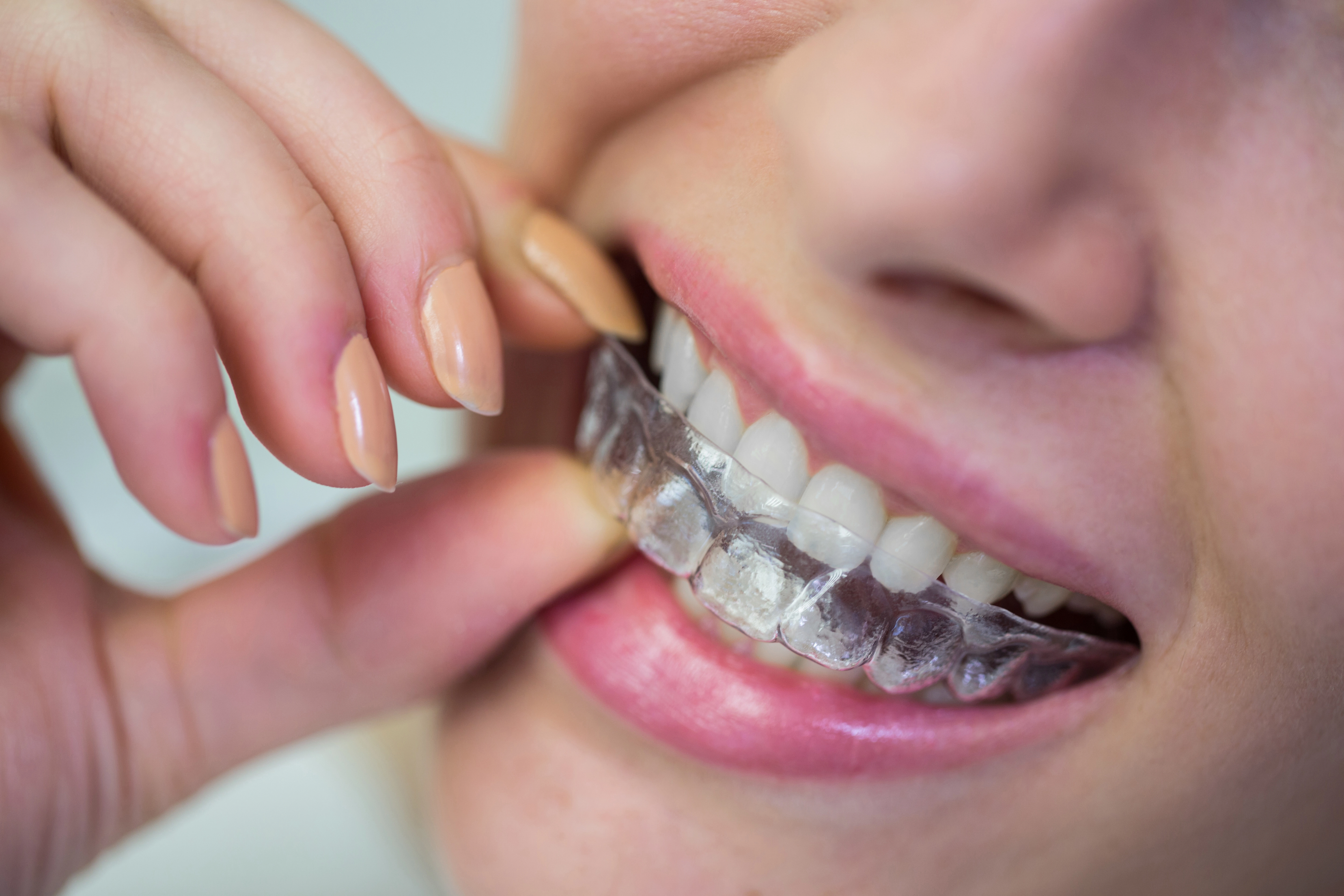 What Dentists Evaluate Before Recommending Invisalign Clear Braces